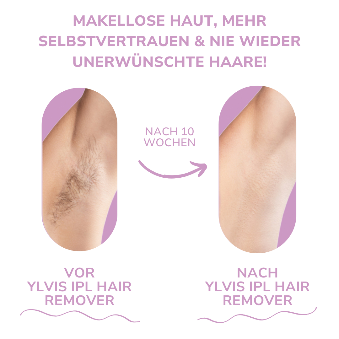 Ylvis IPL Hair Remover - Nanorasierer für seidig glatte Haut in Sekunden